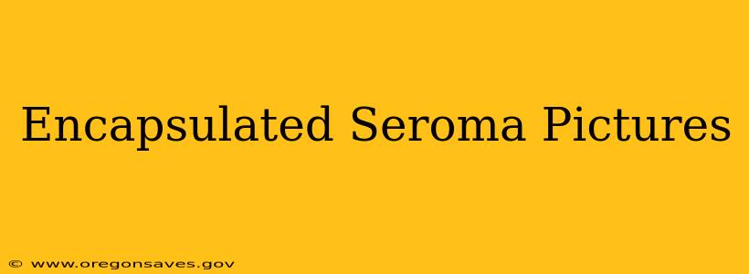 Encapsulated Seroma Pictures
