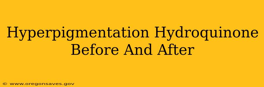 Hyperpigmentation Hydroquinone Before And After