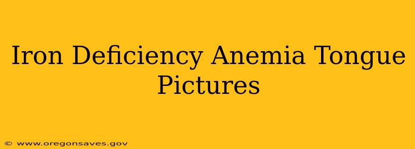 Iron Deficiency Anemia Tongue Pictures