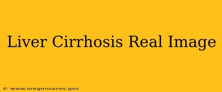 Liver Cirrhosis Real Image