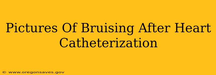 Pictures Of Bruising After Heart Catheterization