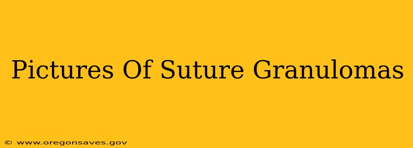 Pictures Of Suture Granulomas
