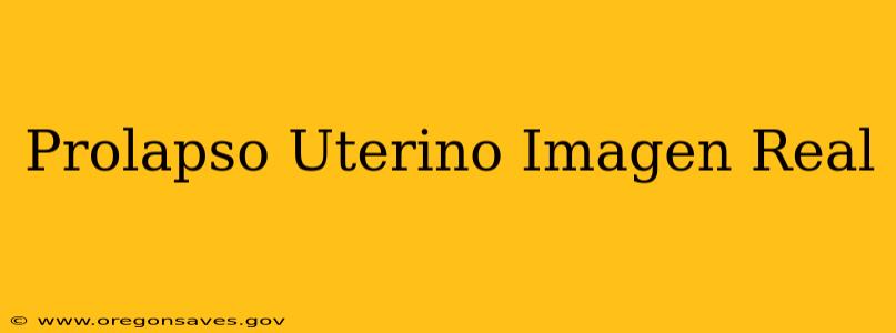 Prolapso Uterino Imagen Real